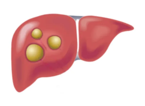 Liver Cyst Surgery - Laparoscopic De-Roofing / Fenestration consultation at Niraaya Hospital